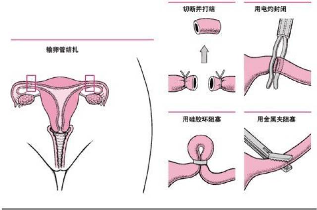 不管是男性结扎,还是女性结扎,总有人搞不清扎的是哪个部位.