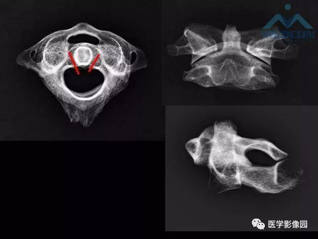 寰枢关节脱位的影像诊断