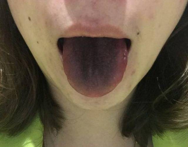 这种颜色的舌头非常的少见,但不是没有,发生的人群多是因为真菌的感染