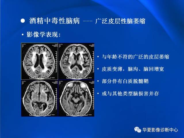 酒精中毒性脑病的影像诊断