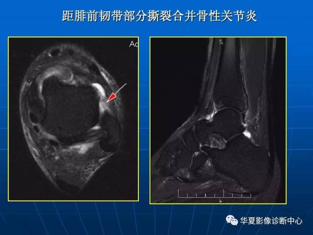 踝关节损伤的磁共振扫描技术及诊断