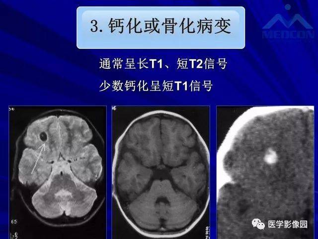 脑部短t2信号病变的影像学诊断与鉴别 影像天地