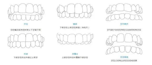素素探店 | 牙齿矫正的101种方式,如何找到最适合你的