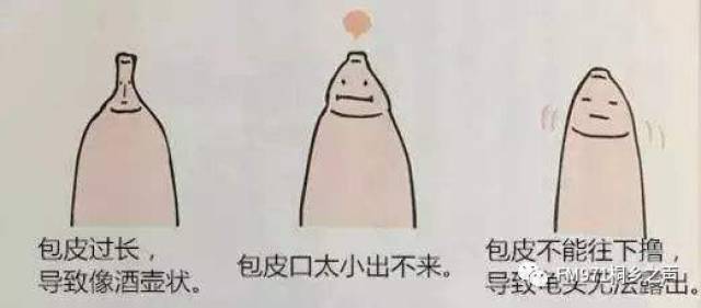 丁生伟:50岁的桐乡老伯,居然还需要进行包皮环切手术!