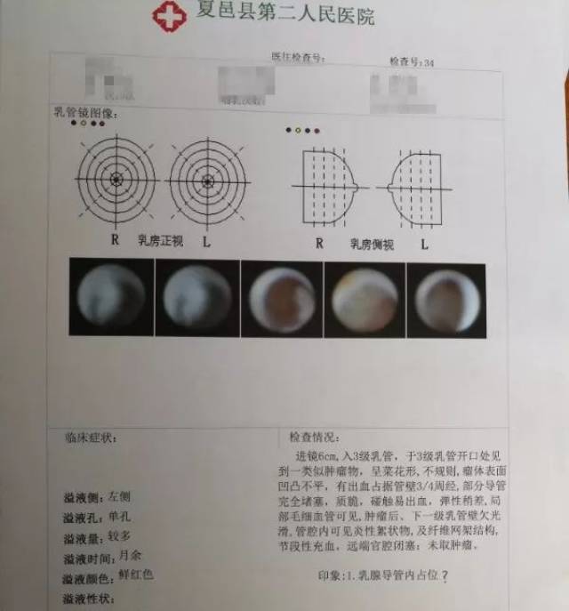 这场乳腺癌大作战,最终以保全双乳而获胜.