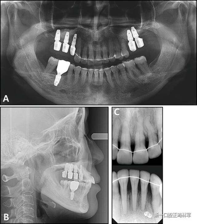 多颗牙齿缺失的牙周炎患者的跨学科综合治疗