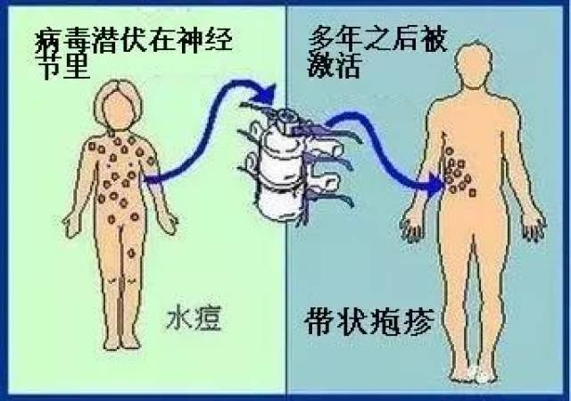 带状疱疹有哪些症状