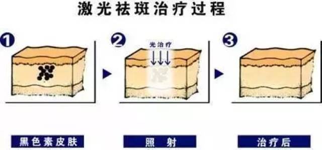 激光祛斑有着突出的优势