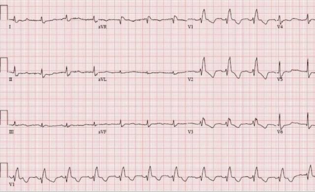 收缩压为50~60 mmhg,心室率60~80次/分,心电图示心房纤颤,qrs时间为