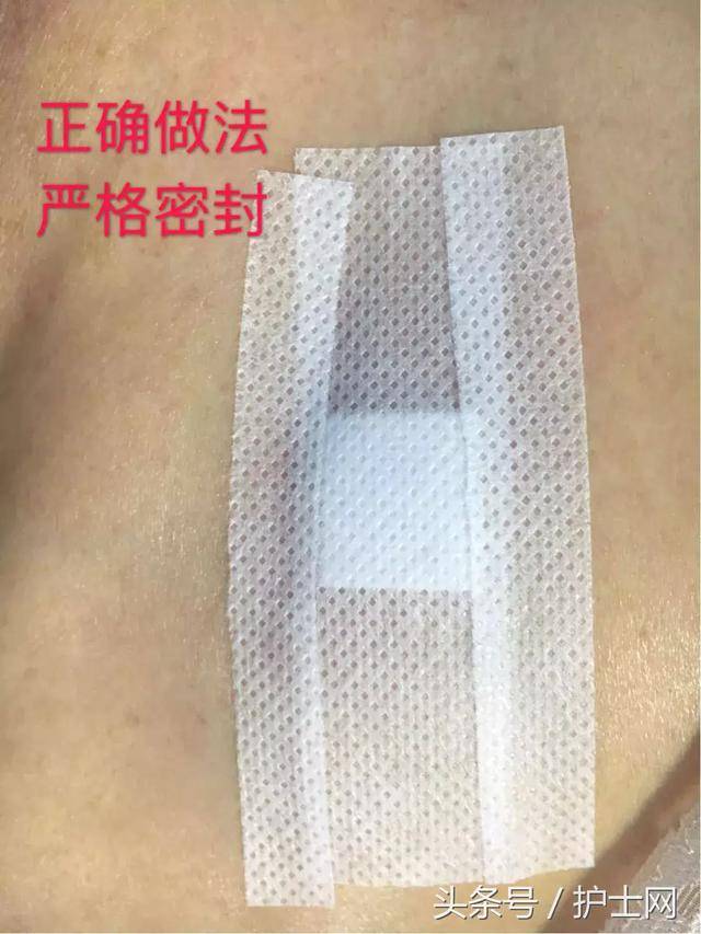 中心静脉导管拔除后,穿刺点如何处理?