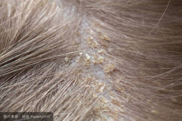 突然大量脱发,可能是因为头皮屑太多导致的?