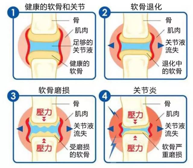 6月23日(周六)明基医院两岸骨科专家将举办"退化性关节炎"专题讲座