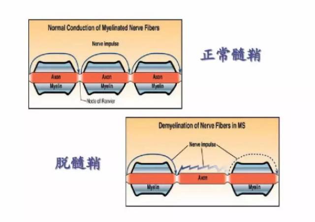 引起脱髓鞘病变的原因①神经纤维髓鞘破坏,形成小的播散性病灶,或由一