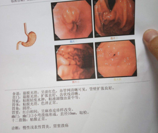 是慢性浅表性胃炎基础上并发的一种胃黏膜急性炎症改变.