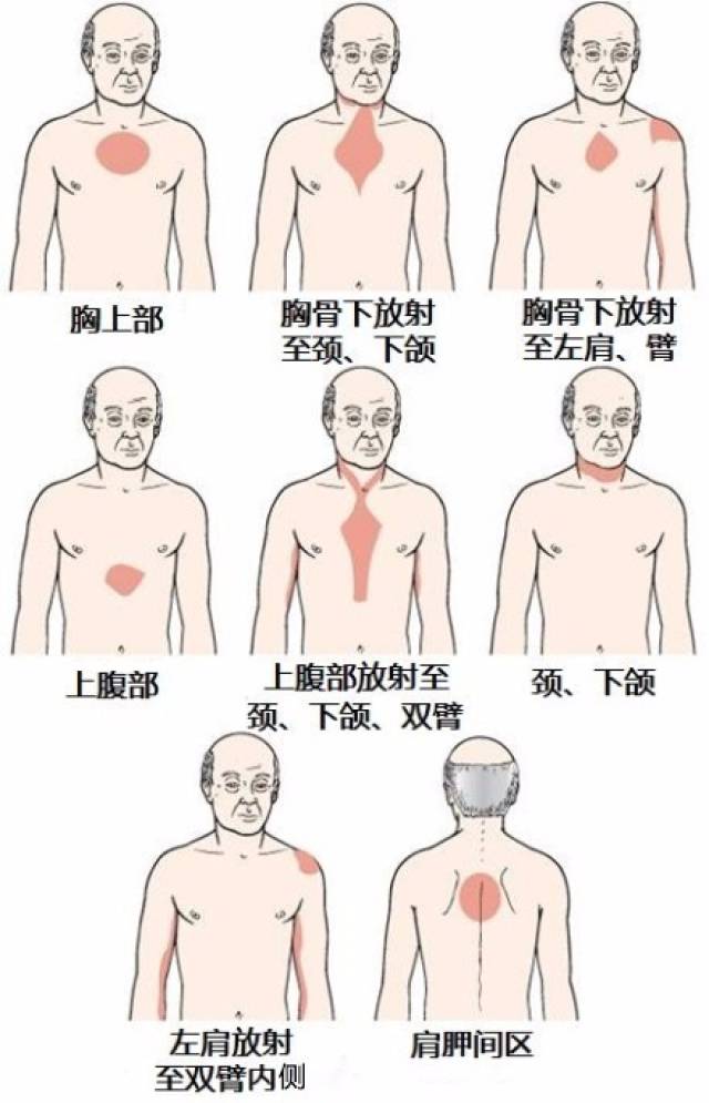 (8)看似无关位置的疼痛 心绞痛,心梗不一定是心痛,异位疼痛是隐匿型