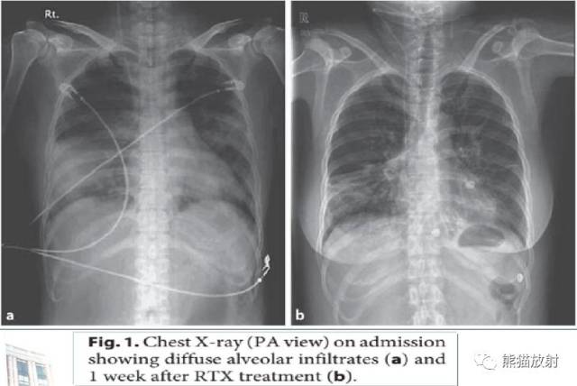 胸片dah示肺部片状阴影,边界模糊,rtx治疗后好转.