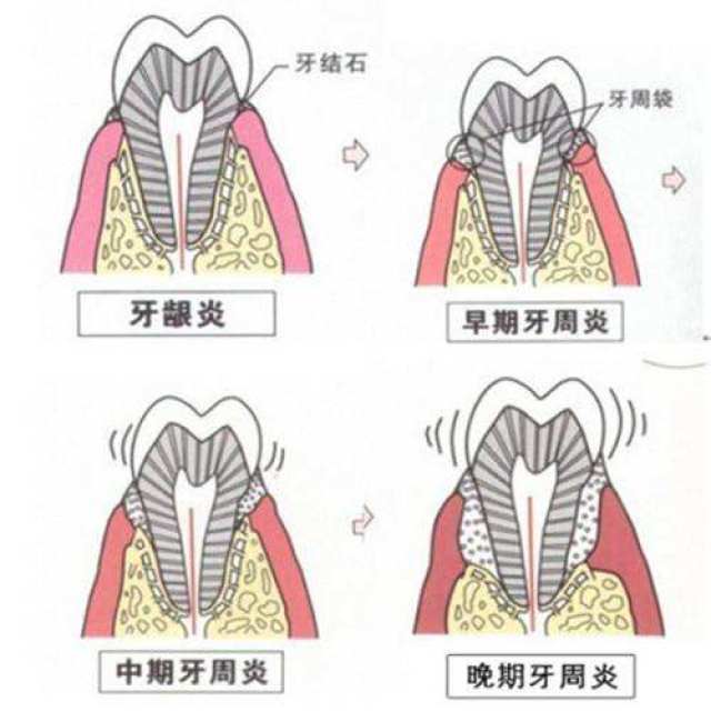 根尖牙周炎越拖越严重,最后不得已做了根管!