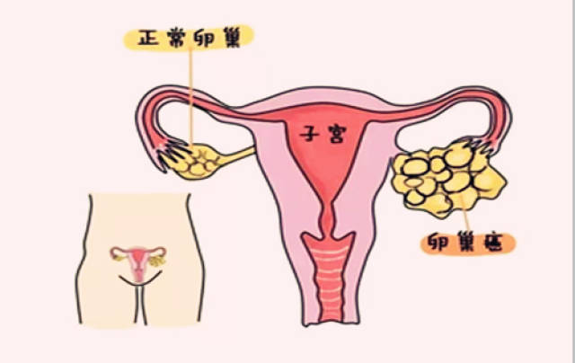 卵巢癌早期症状?