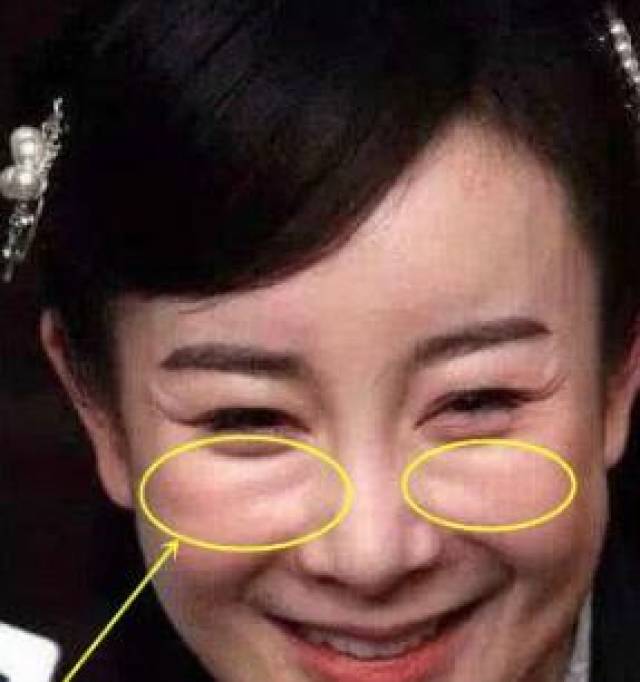 张檬取出假体后,脸上笑沟胜过杨幂?网友:总算变回来了