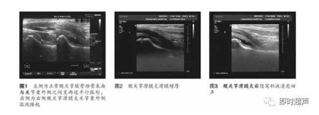 小儿髋关节疾病的超声诊断