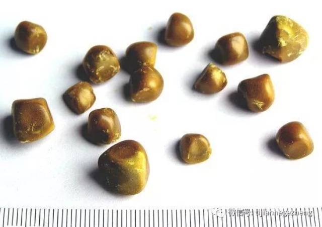 现役飞行员肾结石系列五肾上盏结石肾下盏结石多发性肾结石