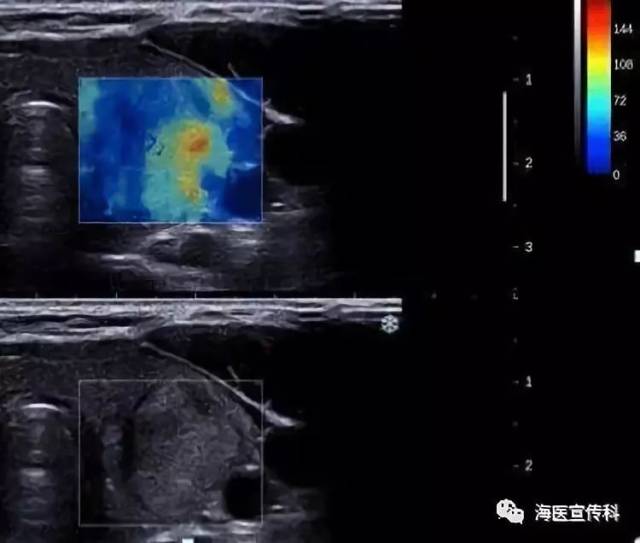 目前, 超声弹性成像分为实时弹性成像和离线弹性成像二种方法,实时