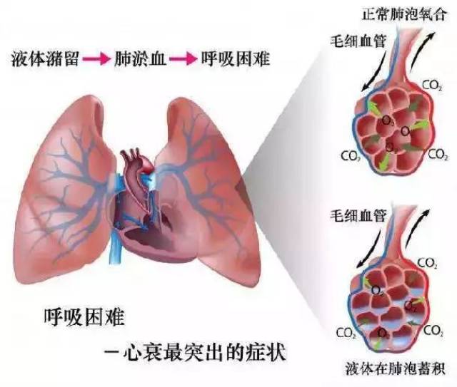 27 ,呼吸困难最常见 左心功能不全 28 ,哪种情况产生急性肺水肿时,宜