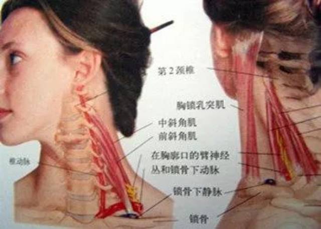 什么是前斜角肌综合征