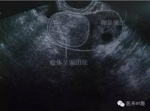 畸胎瘤