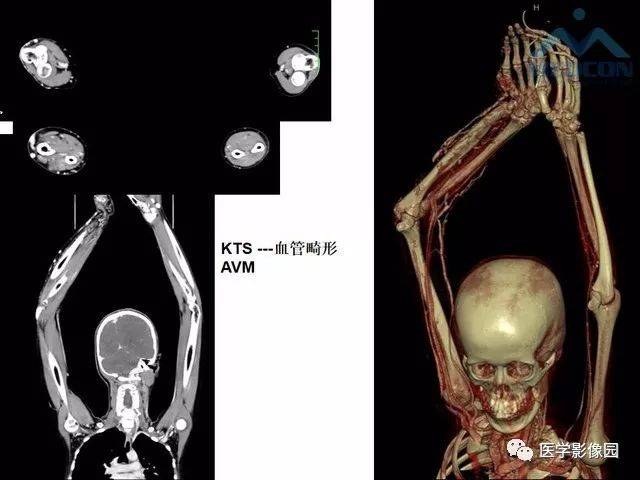 偏侧性肢体肥大症的影像学鉴别诊断 | 影像天地