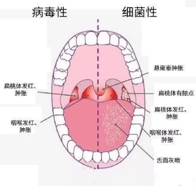 咽扁桃体充血红肿及疼痛比较明显,颜色乌暗,表面