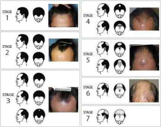脂溢性脱发的过程和分级