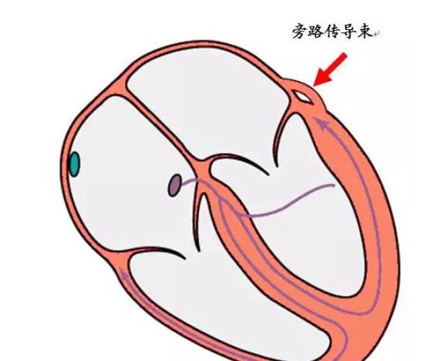 治疗心梗的药 预激综合征心电图4
