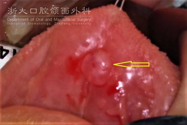 舌前腺囊肿的治疗方法主要 以手术治疗为主,手术不能仅切除囊肿,更要