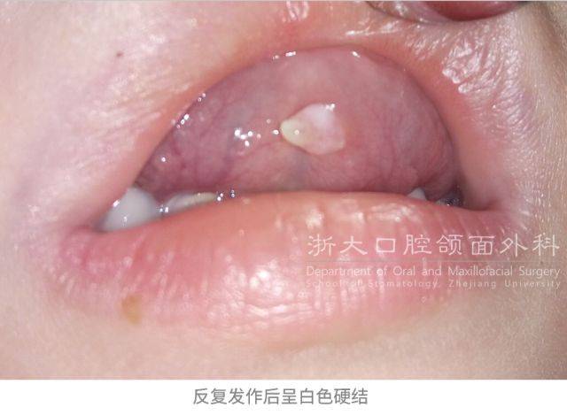 向左滑动查看左侧舌前腺及其囊肿摘除术的图片(手术图片预警,可能