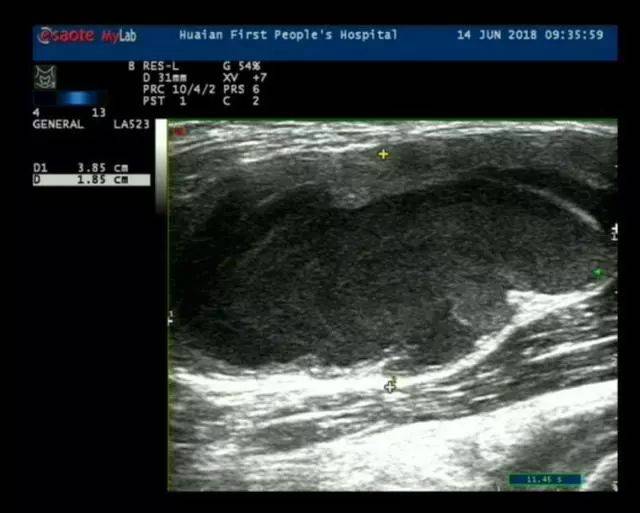 小针办大事 市一院介入超声科运用肌骨超声治疗腘窝囊肿
