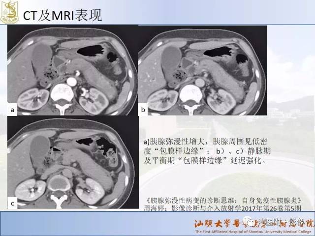 自身免疫性胰腺炎ct及mri特征