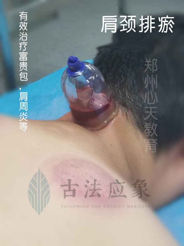 背部排瘀的最佳好处,80%的人都不知道