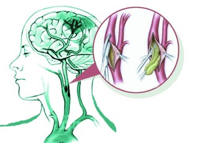 颈动脉狭窄为何要选择手术治疗?