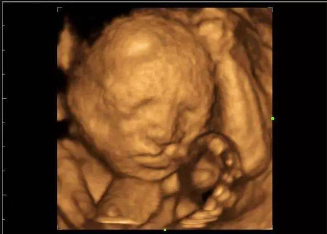6个月胎儿四维查出是兔唇,家人死活不同意生下来,我该怎么办?