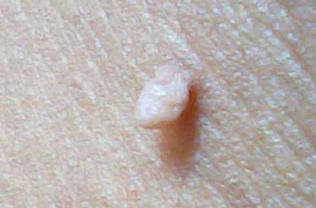 这种情况是由于患者甘油三酯和胆固醇高,导致皮肤出现"皮赘"表现.