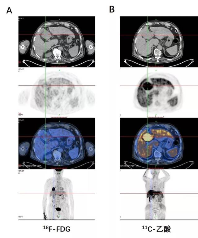 【上海】仁济医院 | 11c-乙酸pet/ct显像用于肝癌临床