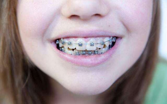 小孩牙齿矫正的最好的年龄有分为几个阶段,适合不一样的牙齿畸形的