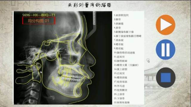 4,当我们在电脑上使用软件测量头影片时,有些解剖会出现两个重叠的