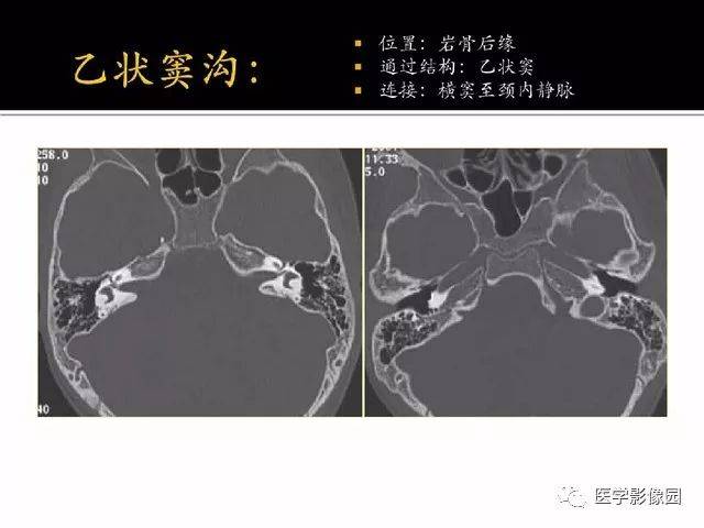 别再说难了,手把手教您学鼻腔鼻窦及颅底ct影像解剖