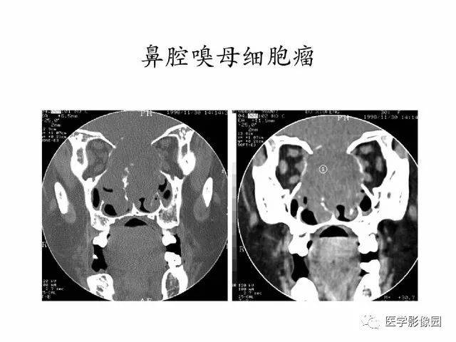 别再说难了,手把手教您学鼻腔鼻窦及颅底ct影像解剖