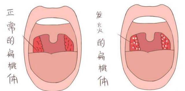 儿童扁桃体术后要注意些什么?