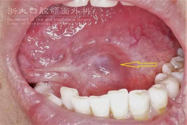 感觉就像口底起了一个水泡一般的疙瘩,不痛;当疙瘩变大时可将舌头顶