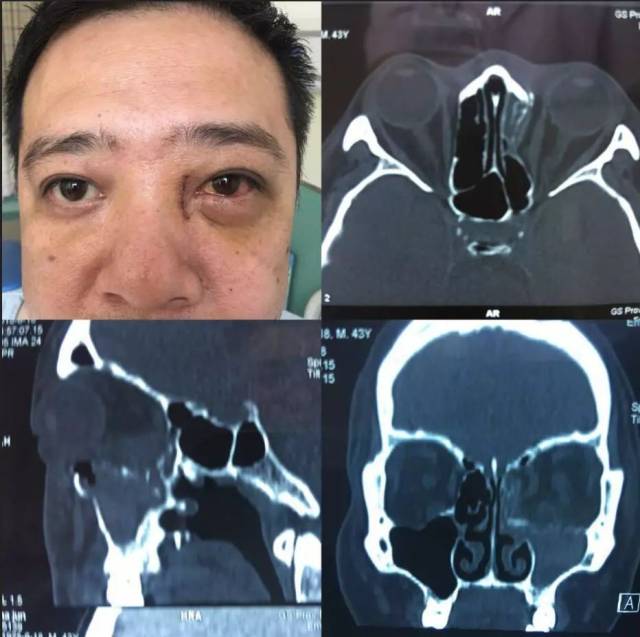 眼科病例分享:外伤后眼球内陷困扰患者 手术修复后非常满意