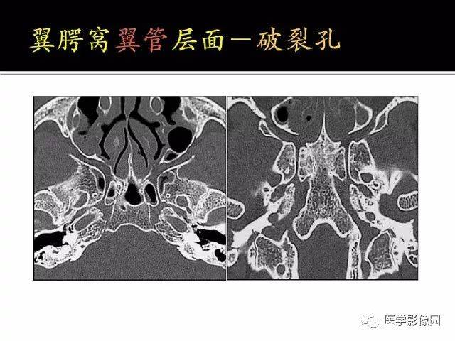 别再说难了,手把手教您学鼻腔鼻窦及颅底ct影像解剖